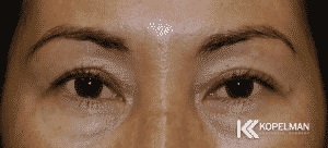Asian Eyelid Crease_before and after picture 2