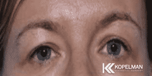 Blepharoplasty new york city _ before & after