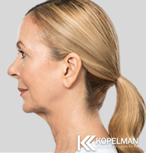 Kybella After Picture 3a