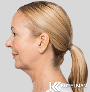 Kybella Before Picture 3a