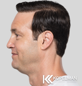 Kybella Before Picture 5a