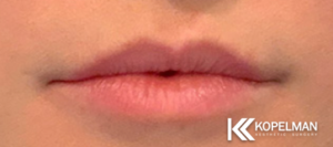 Lip Fillers Before & After _ 3