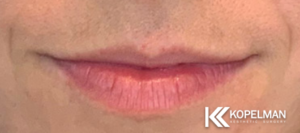 Lip Fillers Before & After _Pic 1