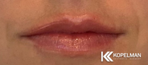 Lip Fillers Before & After _Pic 2