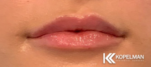 Lip Fillers Before & After _Pic 4