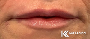 Lip Injections NYC _Before & After 2