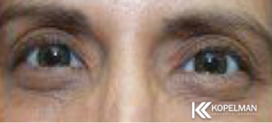 Ptosis before and after photo 2