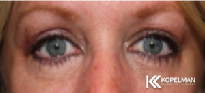 Ptosis repair After Picture