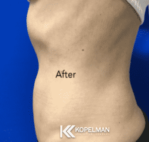 Ultrashape After Picture 3