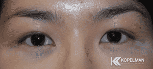 asian blepharoplasty NYC_before and after picture 2
