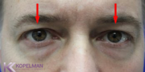 blepharoplasty NYC_before & after