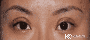 blepharoplasty on asian eyes_before and after picture 2