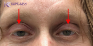 male blepharoplasty before and after 1