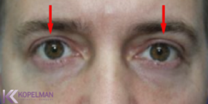 men_blepharoplasty before and after
