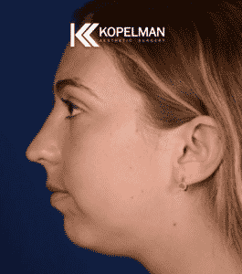 Chin Implants Before & After Picture 2