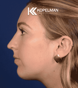 Chin Implants Before & After Picture 3