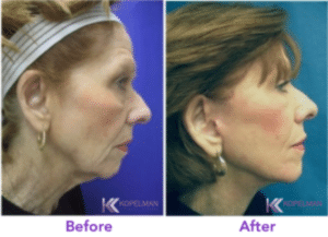 Best Mini-Facelift Before & After NYC