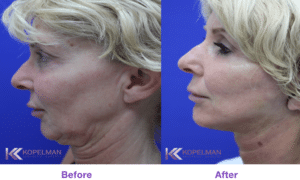 FaceLift-Before-After
