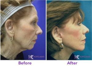 best-mini-face-lift-before-and-after-photos-300x217