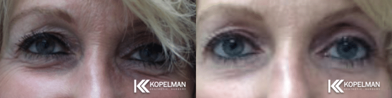 Before & After Blepharoplasty
