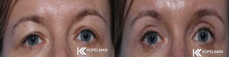 Before & After Cosmetic Eyelid Surgery