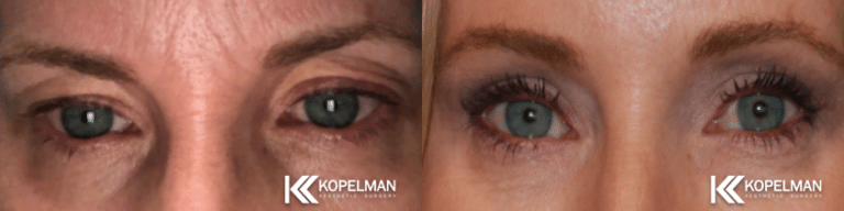 Blepharoplasty Before and After pictures