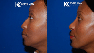 Chin Implant Before & After Picture