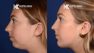 Chin Implant Before & After _ Young Woman