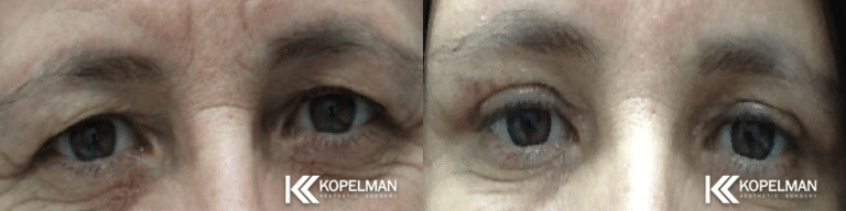 Cosmetic Eyelid Surgery Before and After