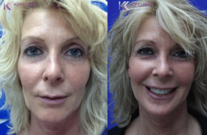 Female Facelift Before & After