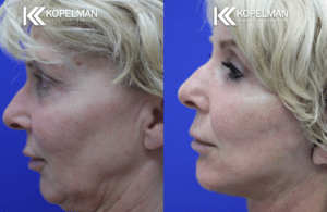 Female Facelift Before & After Photo