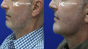 Male Chin Implant Before & After