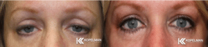 Ptosis Repair Before & After Pictures