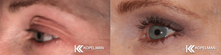 Upper Eyelid Before And After Photo