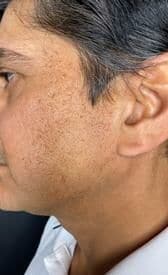 Microneedling After picture 3