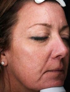 Microneedling before picture 2