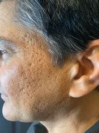 Microneedling before picture 3