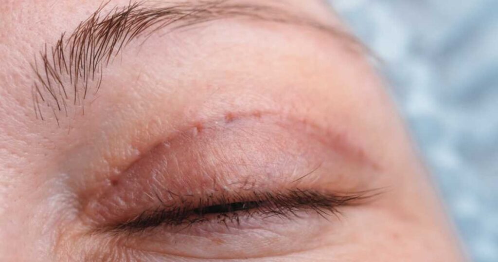 Blepharoplasty Recovery