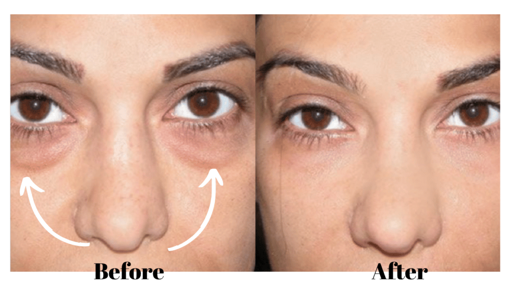 fat-injections-under-your-eyes-how-to-do-it-right