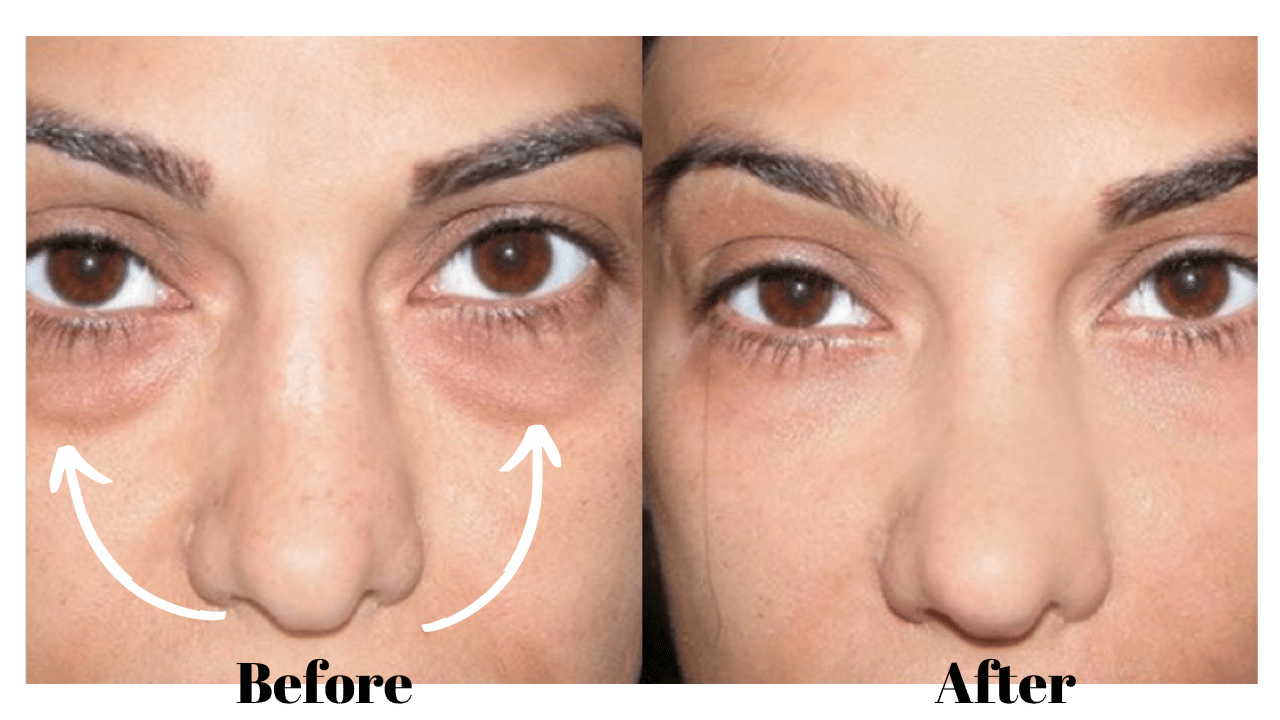 Fat Injections Under Your Eyes How To Do It Right