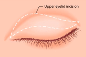 Upper eyelid surgery cost
