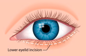 lower eyelid surgery cost