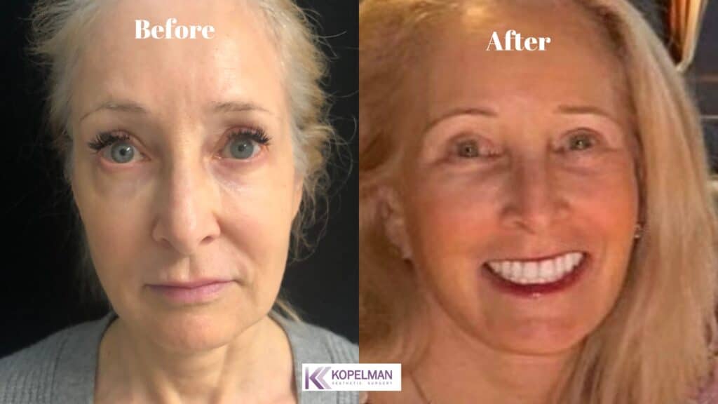 Facelift Before and After Front View _ Patient 1a
