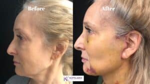 Facelift Before and After Side View _ Patient 1