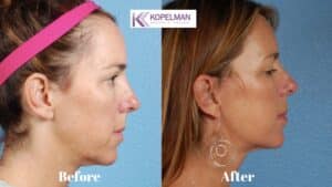 Mini Facelift before and after _ female patient 1