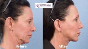 Mini Facelift before and after _ female patient 2