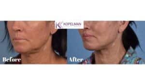 Mini Facelift before and after _ female patient 4a