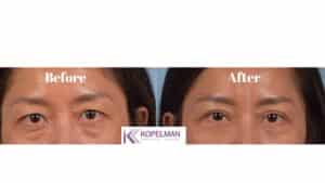 asian eyelids surgery before and after _ female patient 1