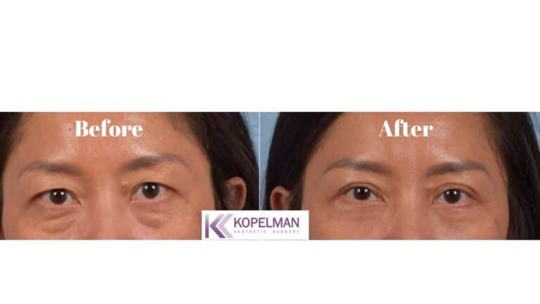 asian eyelids surgery before and after _ female patient 1