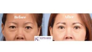 asian eyelids surgery before and after _ female patient 2